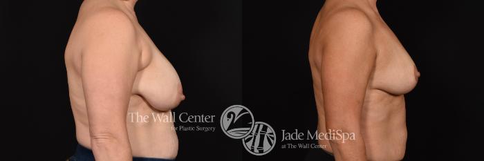 Breast Lift with SAFELipo & Fat Grafting Right Side Photo, Shreveport, Louisiana, The Wall Center for Plastic Surgery, Case 960