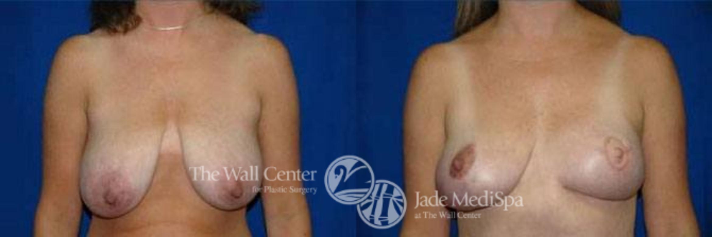 Before & After Breast Reconstruction Case 137 View #1 View in Shreveport, LA