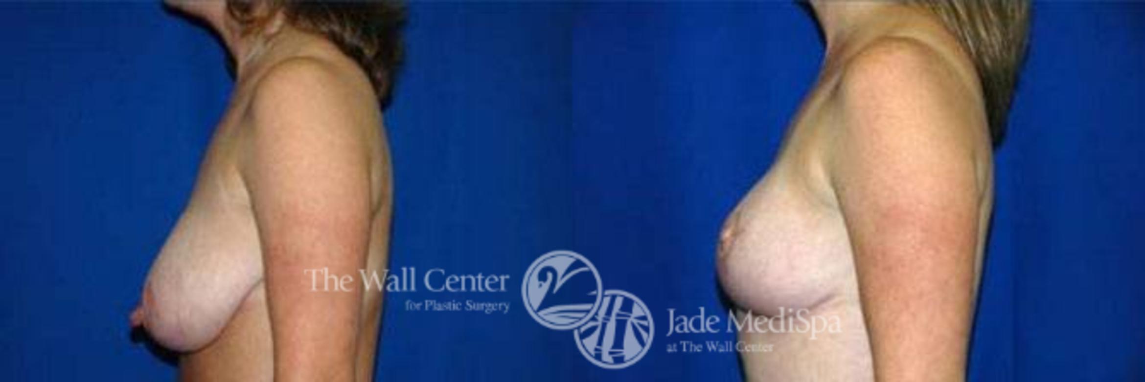 Before & After Breast Reconstruction Case 137 View #3 View in Shreveport, LA