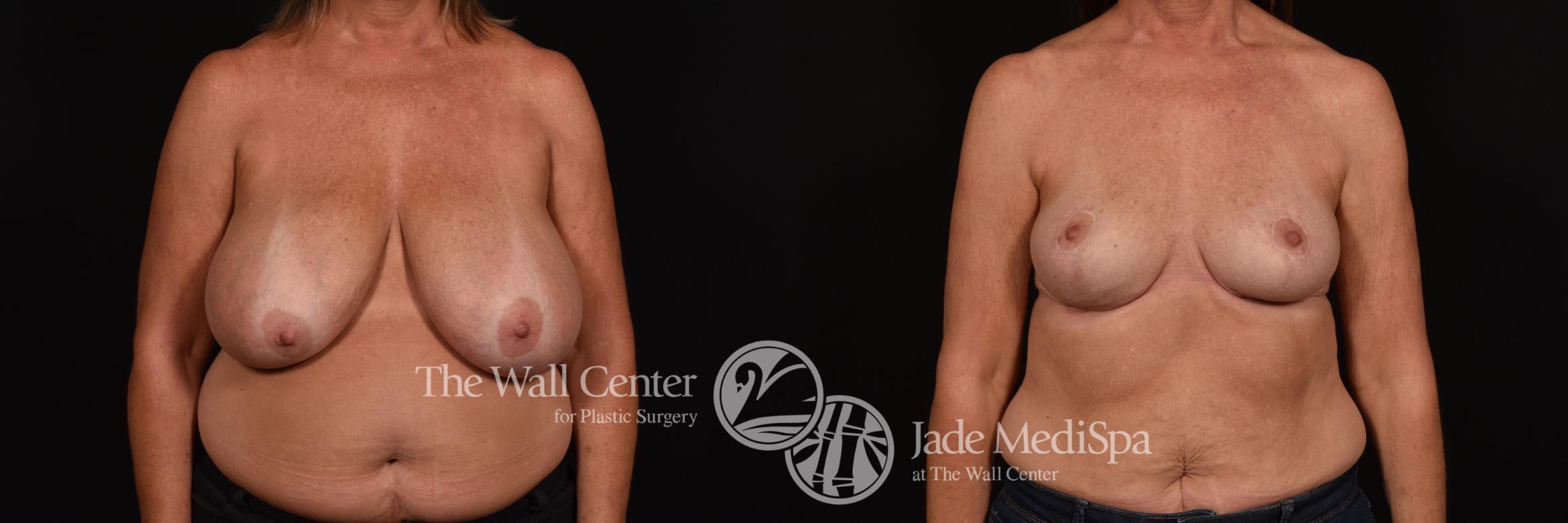 Before & After Breast Reduction Case 1009 Front View in Shreveport, LA