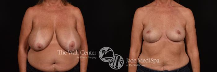 Before & After Breast Reduction Case 1009 Front View in Shreveport, LA