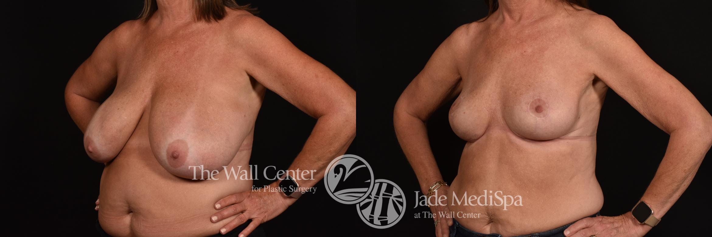 Before & After Breast Reduction Case 1009 Left Oblique View in Shreveport, LA