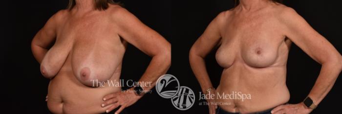 Before & After Breast Reduction Case 1009 Left Oblique View in Shreveport, LA