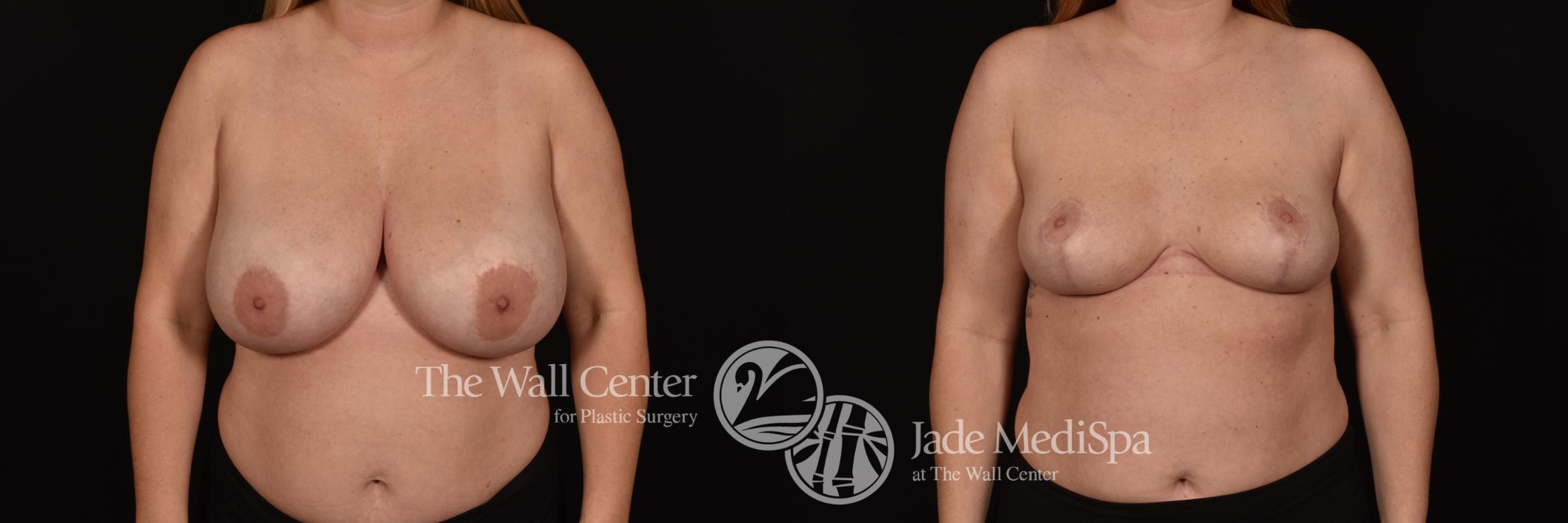 Before & After Breast Reduction Case 1065 Front View in Shreveport, LA