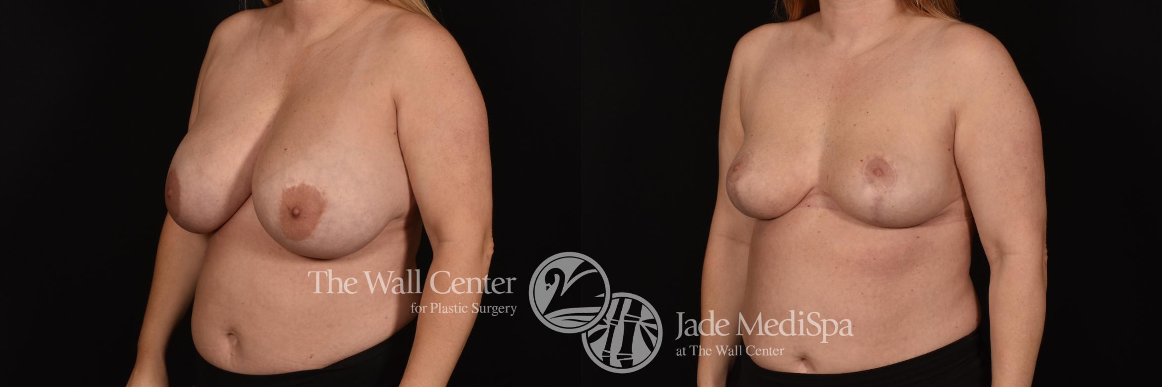 Before & After Breast Reduction Case 1065 Left Oblique View in Shreveport, LA