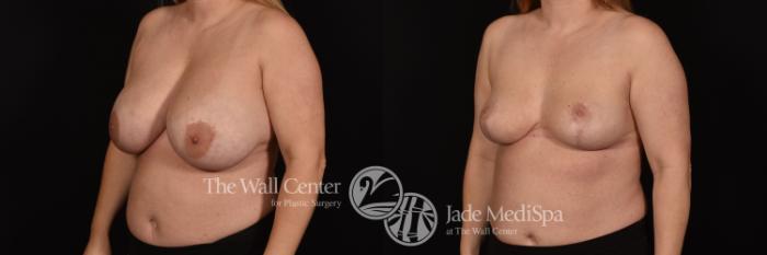Before & After Breast Reduction Case 1065 Left Oblique View in Shreveport, LA