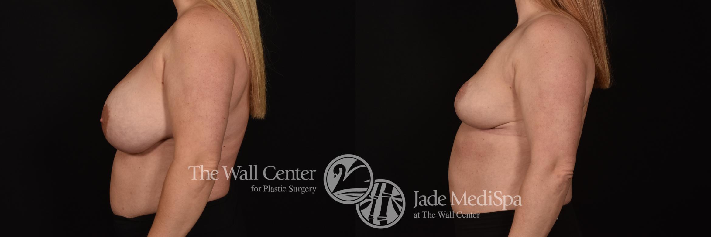 Before & After Breast Reduction Case 1065 Left Side View in Shreveport, LA