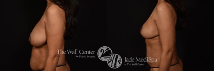 Before & After Breast Reduction Case 1090 Left Side View in Shreveport, LA