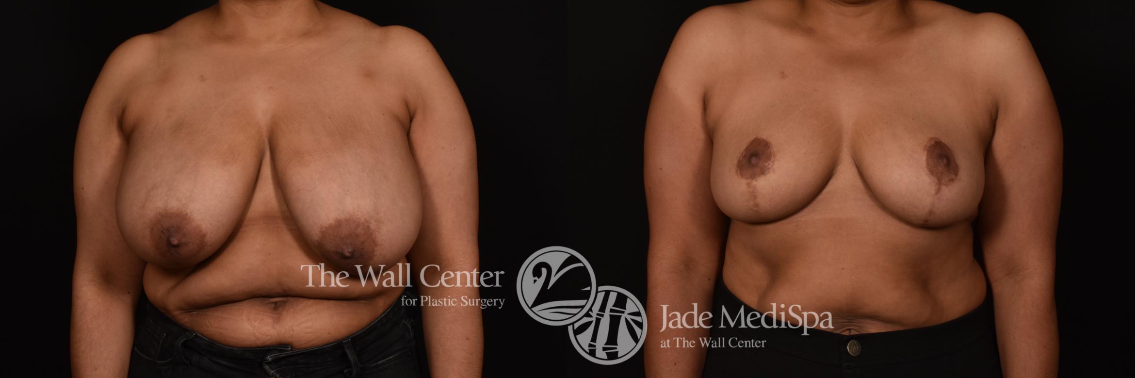Before & After Breast Reduction Case 1116 Front View in Shreveport, LA