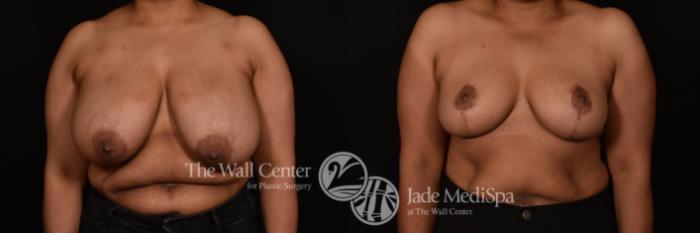 Before & After Breast Reduction Case 1116 Front View in Shreveport, LA