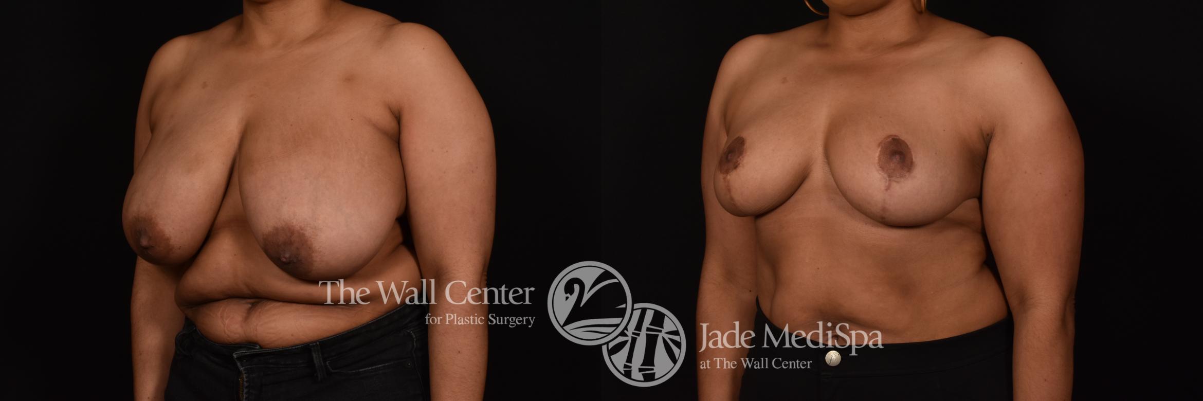 Before & After Breast Reduction Case 1116 Left Oblique View in Shreveport, LA