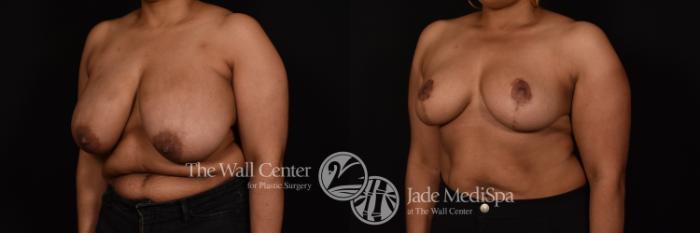 Before & After Breast Reduction Case 1116 Left Oblique View in Shreveport, LA