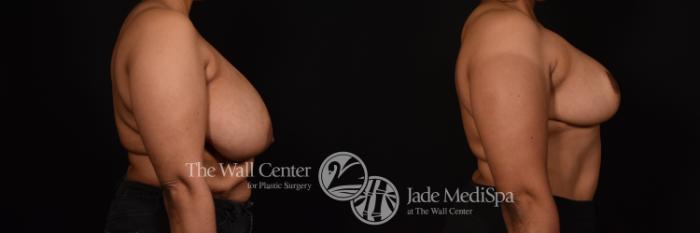 Before & After Breast Reduction Case 1116 Right Side View in Shreveport, LA