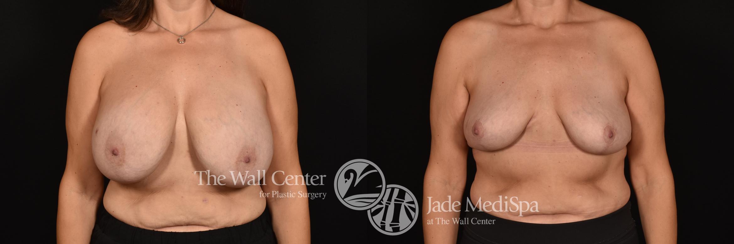 Before & After Breast Reduction Case 1167 Front View in Shreveport, LA