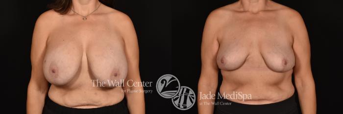 Before & After Breast Reduction Case 1167 Front View in Shreveport, LA