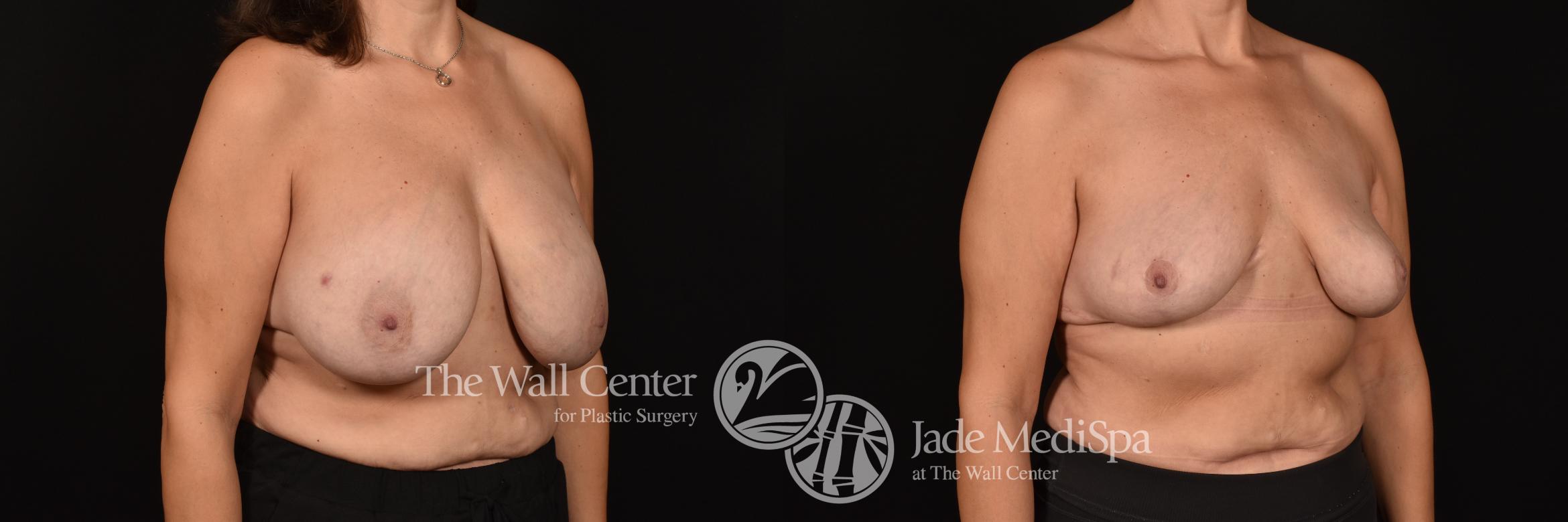 Before & After Breast Reduction Case 1167 Right Oblique View in Shreveport, LA