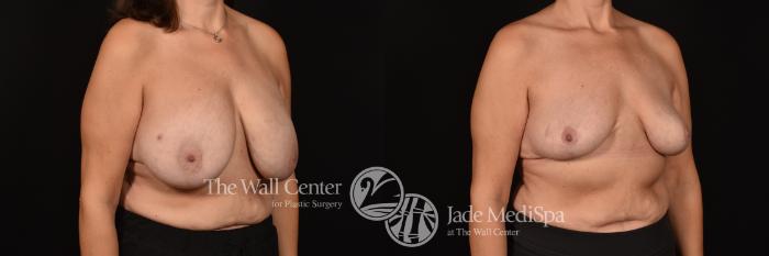 Before & After Breast Reduction Case 1167 Right Oblique View in Shreveport, LA