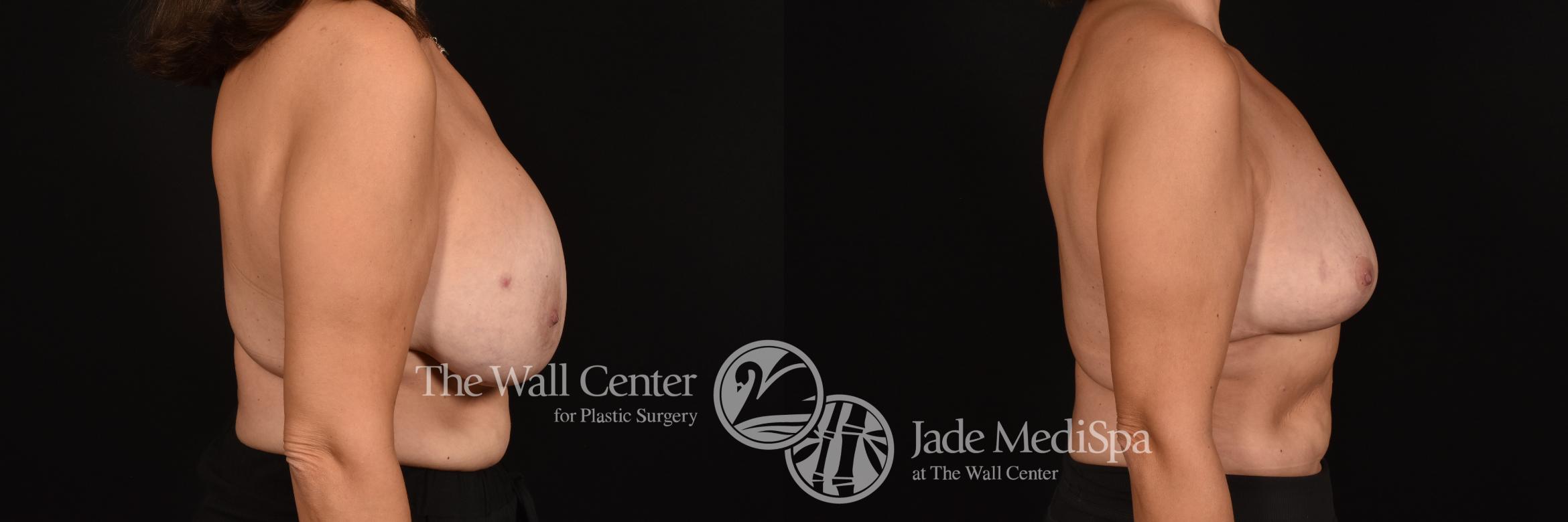 Before & After Breast Reduction Case 1167 Right Side View in Shreveport, LA