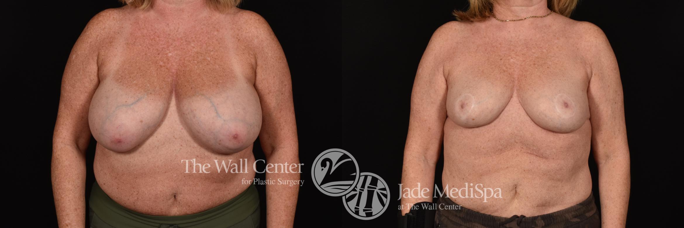 Before & After Breast Reduction Case 1172 Front View in Shreveport, LA