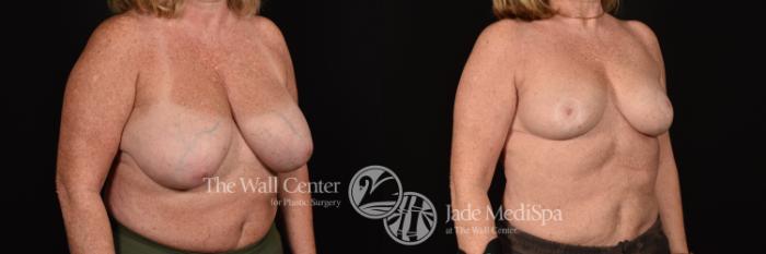 Before & After Breast Reduction Case 1172 Right Oblique View in Shreveport, LA