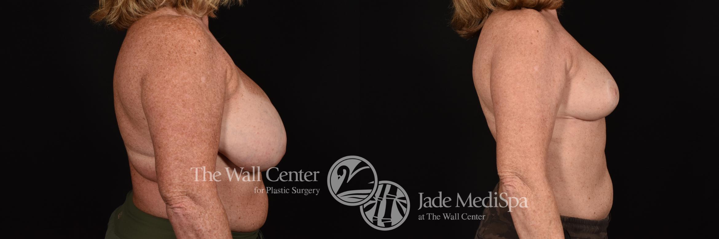 Before & After Breast Reduction Case 1172 Right Side View in Shreveport, LA