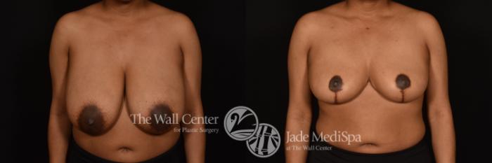 Before & After Breast Reduction Case 1220 Front View in Shreveport, LA