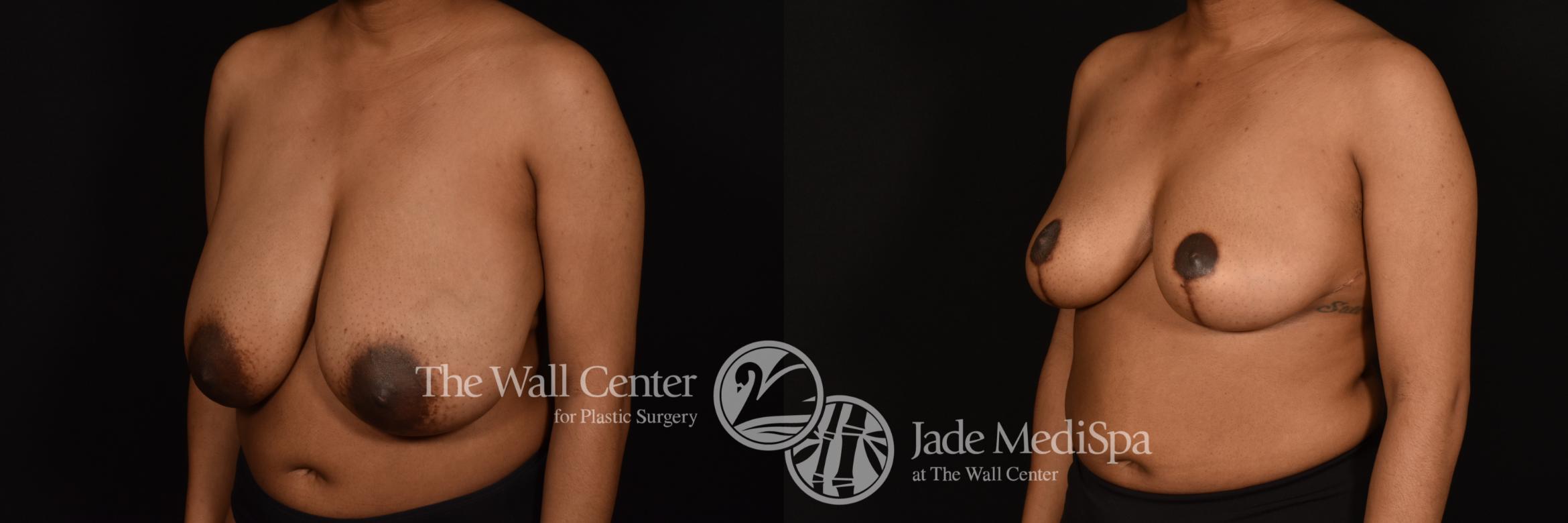 Before & After Breast Reduction Case 1220 Left Oblique View in Shreveport, LA