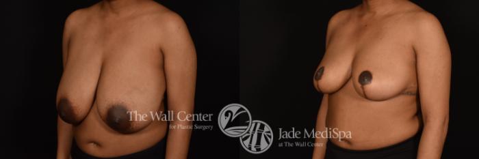 Before & After Breast Reduction Case 1220 Left Oblique View in Shreveport, LA