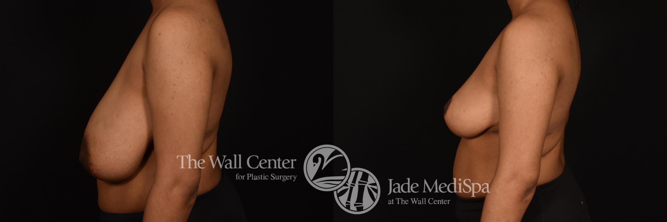 Before & After Breast Reduction Case 1220 Left Side View in Shreveport, LA