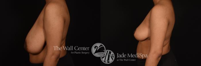 Before & After Breast Reduction Case 1220 Left Side View in Shreveport, LA