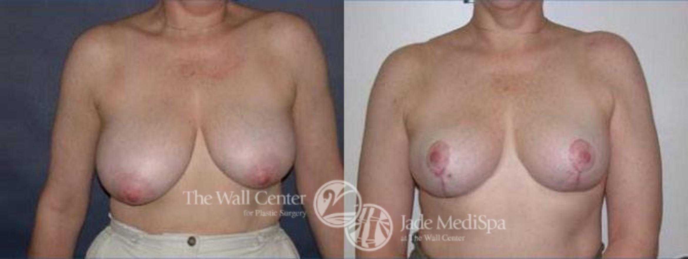 Before & After Breast Reduction Case 133 View #1 View in Shreveport, LA