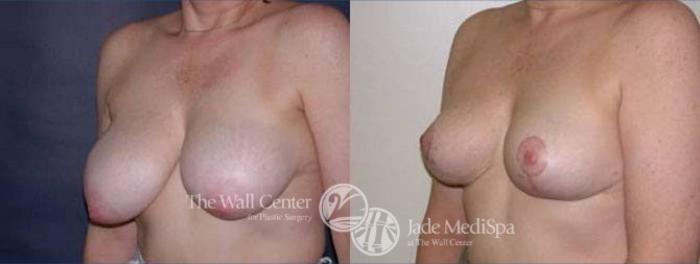 Before & After Breast Reduction Case 133 View #2 View in Shreveport, LA