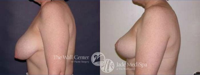 Before & After Breast Reduction Case 133 View #3 View in Shreveport, LA