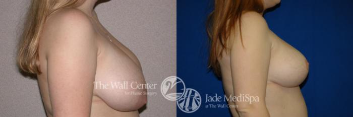 Before & After Breast Reduction Case 202 View #3 View in Shreveport, LA