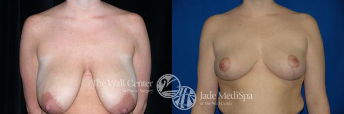 Before & After Breast Reduction Case 204 View #1 View in Shreveport, LA