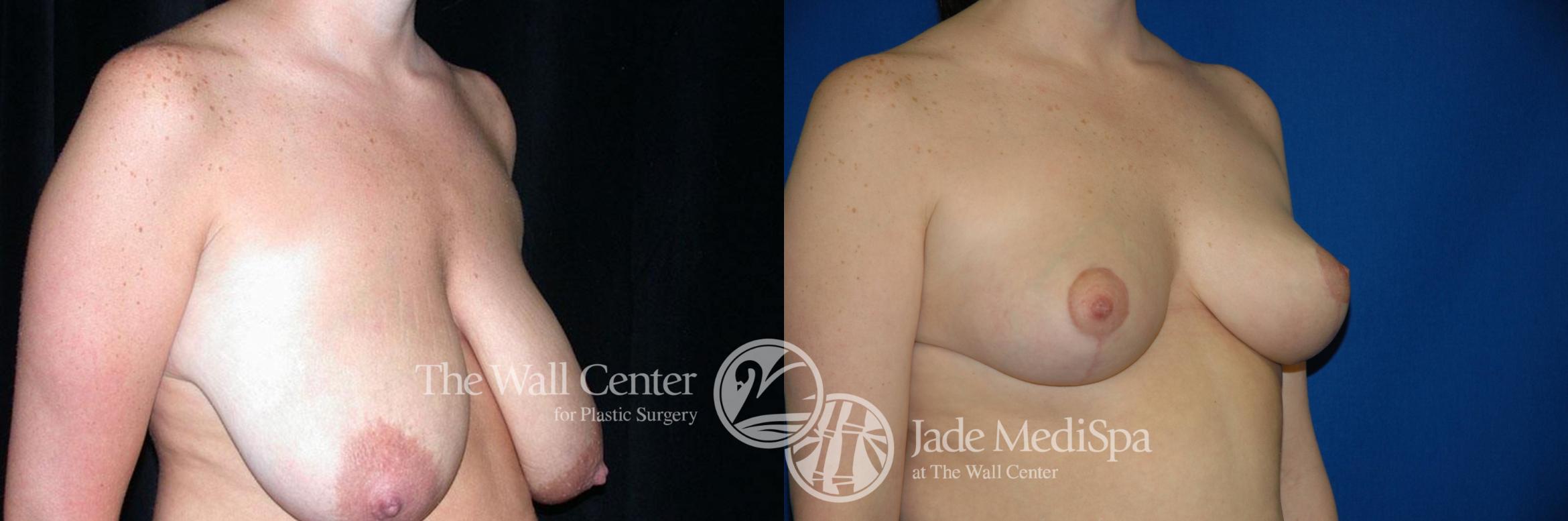 Before & After Breast Reduction Case 204 View #2 View in Shreveport, LA
