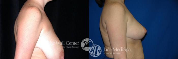 Before & After Breast Reduction Case 204 View #3 View in Shreveport, LA