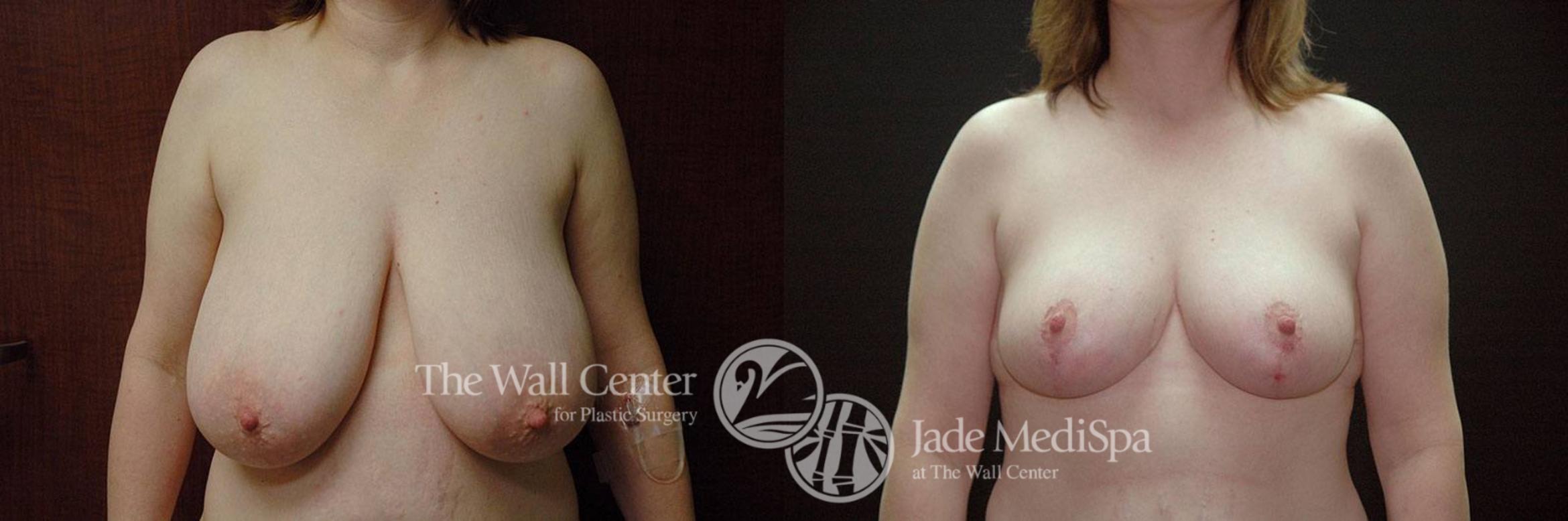 Before & After Breast Reduction Case 254 View #1 View in Shreveport, LA