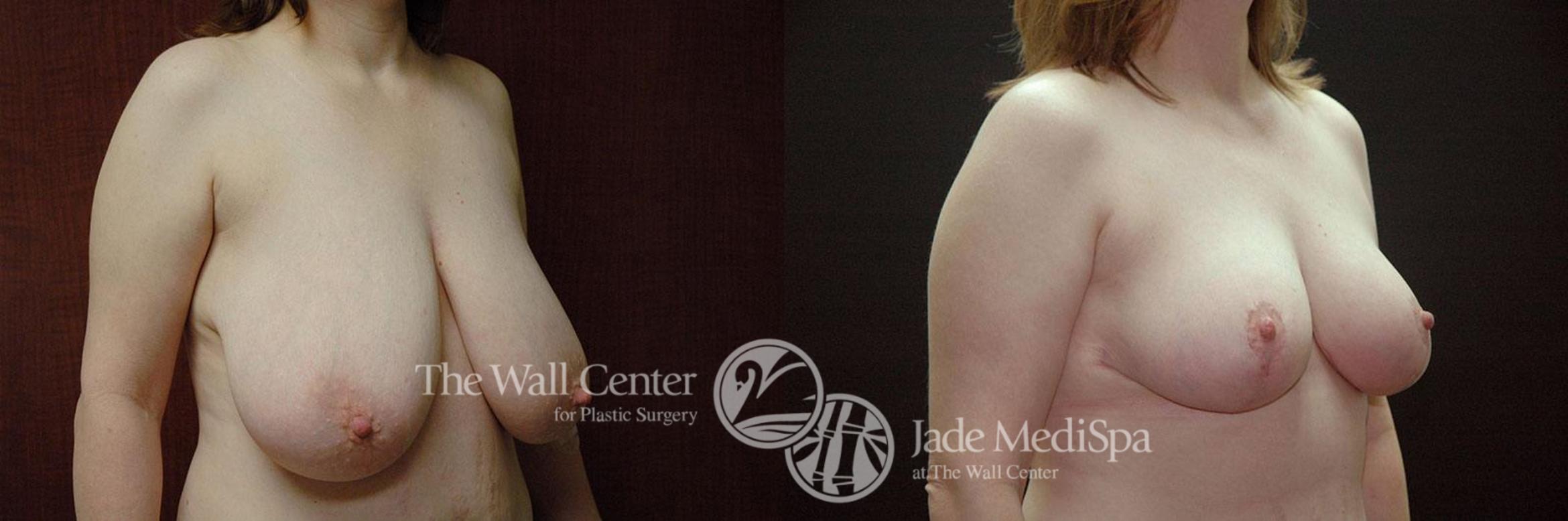 Before & After Breast Reduction Case 254 View #2 View in Shreveport, LA