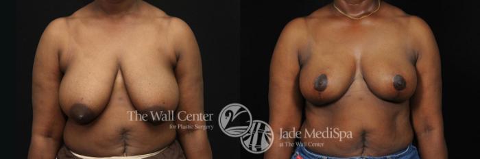 Before & After Breast Reduction Case 315 View #1 View in Shreveport, LA
