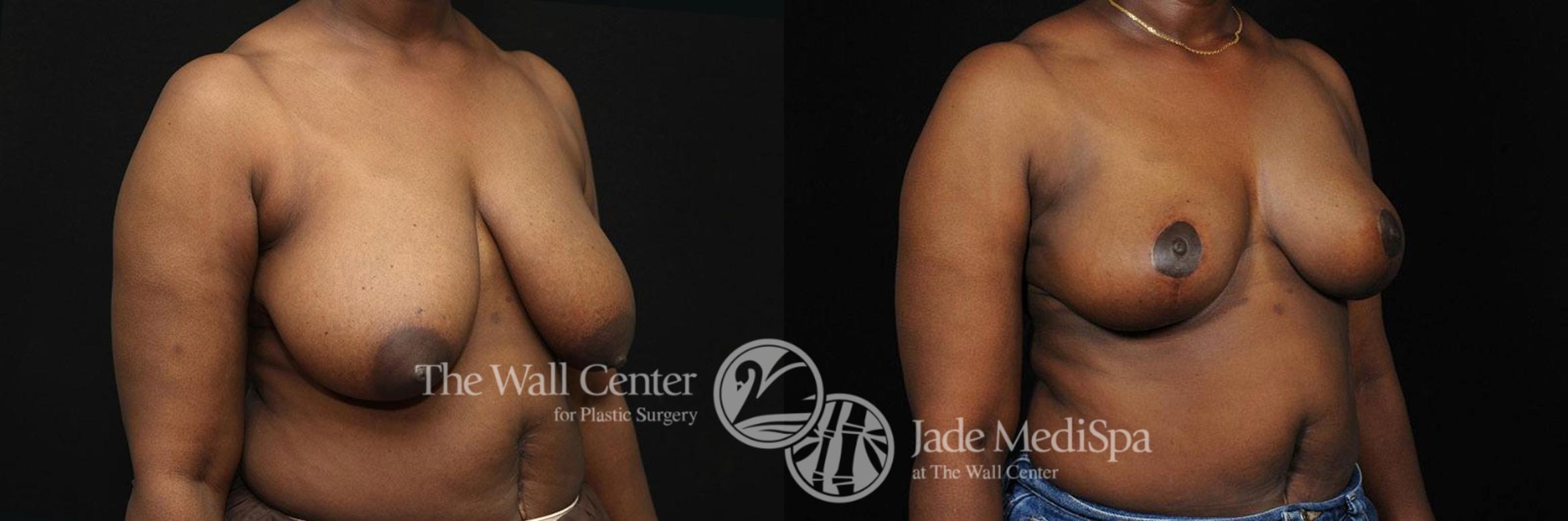 Before & After Breast Reduction Case 315 View #2 View in Shreveport, LA