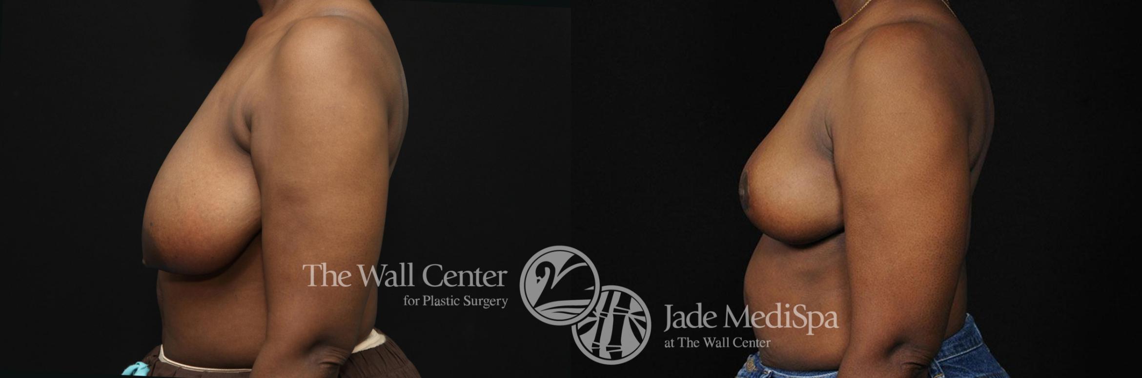 Before & After Breast Reduction Case 315 View #3 View in Shreveport, LA