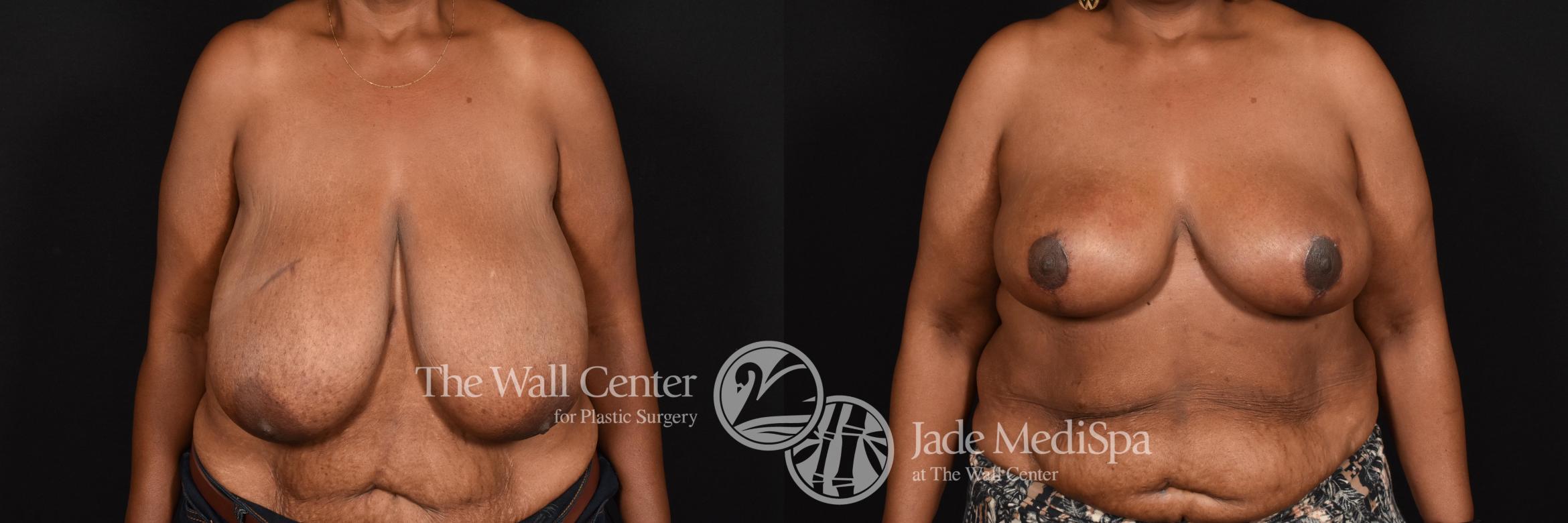 Breast Reduction Case 593 Before & After View #1 | Shreveport, LA | The Wall Center