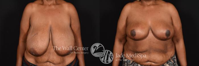 Before & After Breast Reduction Case 593 View #1 View in Shreveport, LA