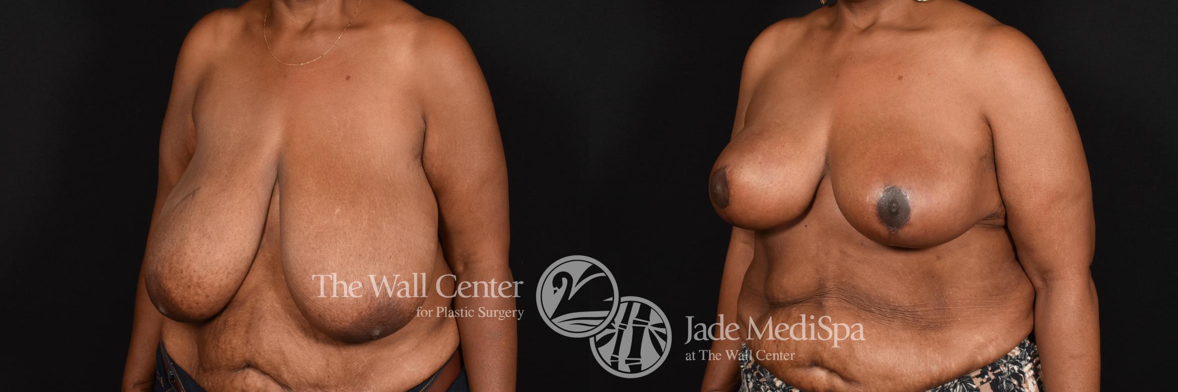 Before & After Breast Reduction Case 593 View #2 View in Shreveport, LA