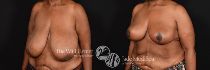 Before & After Breast Reduction Case 593 View #2 View in Shreveport, LA