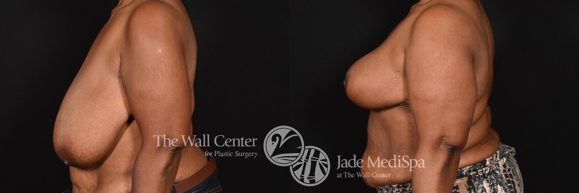 Before & After Breast Reduction Case 593 View #3 View in Shreveport, LA