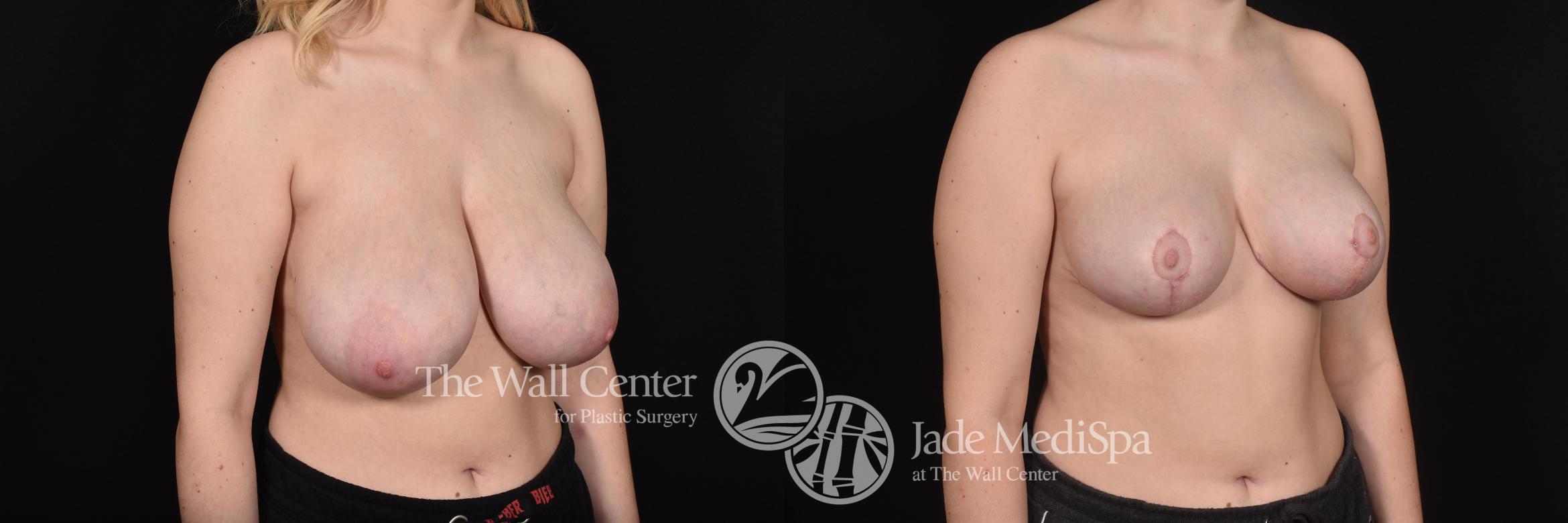 Before & After Breast Reduction Case 600 View #2 View in Shreveport, LA