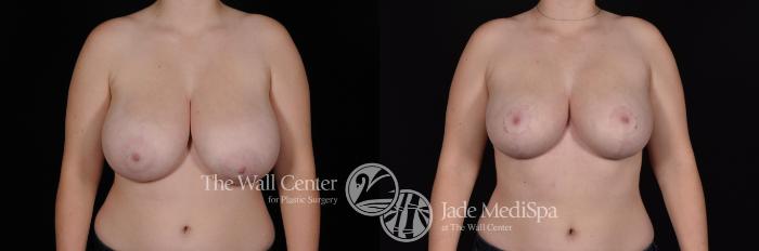 Before & After Breast Reduction Case 610 View #1 View in Shreveport, LA