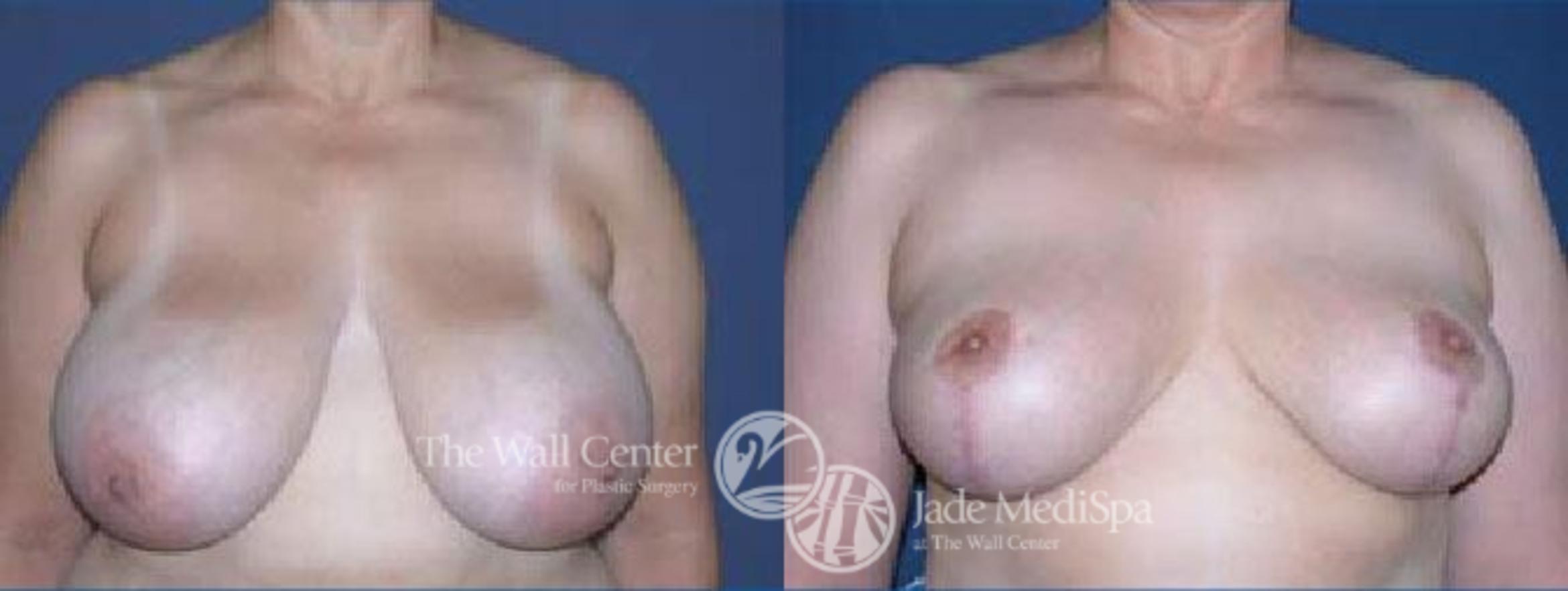 Before & After Breast Reduction Case 67 View #1 View in Shreveport, LA